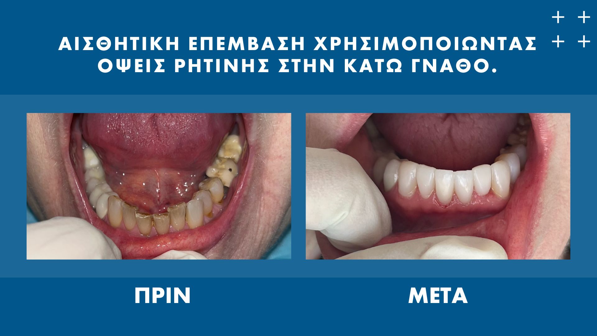 Όψεις Ρητίνης, Περιστατικό | Οδοντίατρος Αθήνα, Ελληνικό, Αργυρούπολη