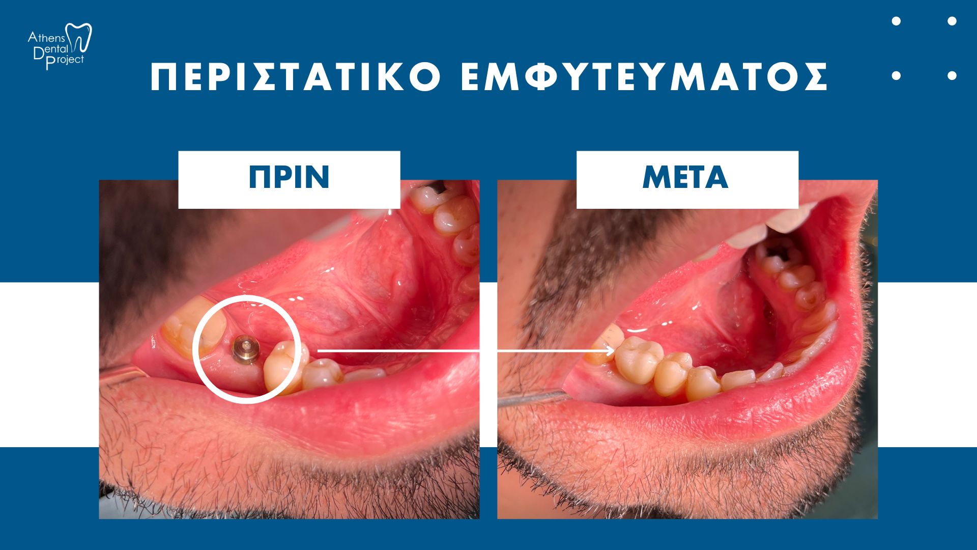 Εμφύτευμα Δοντιών, Περιστατικό | | Οδοντίατρος Αργυρούπολη, Αθήνα, Ελληνικό