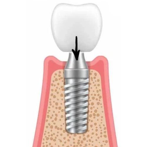 Διαδικασία Εμφυτεύματος Δοντιού