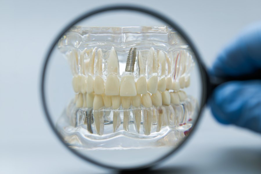 Παρενέργειες εμφυτευμάτων δοντιών: Τι είναι φυσιολογικό και τι πρέπει να σας ανησυχεί