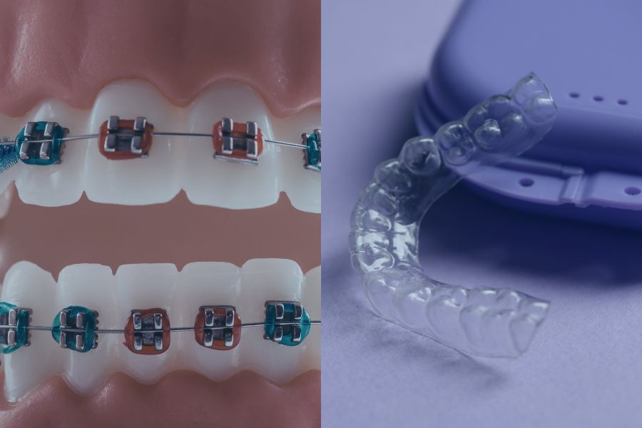 Στοματική υγιεινή με νάρθηκες / σιδεράκια: τι αλλάζει στην καθημερινότητα