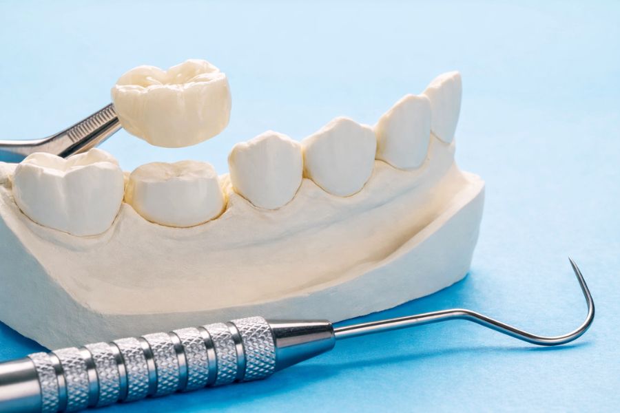 Θήκη Δοντιού: Πότε τη χρειάζομαι, γιατί πονάει ή ενοχλεί, και τι γίνεται αν έχει μπει χρόνια πριν